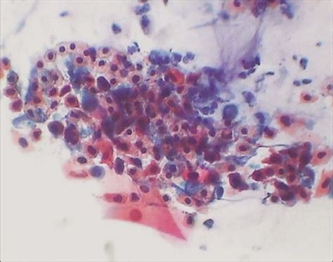 what is coccobacilli in pap smear|The Pap smear in inflammation and repair .